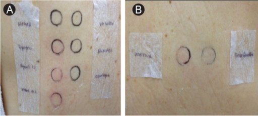 File:Patch test for antihistamines.png