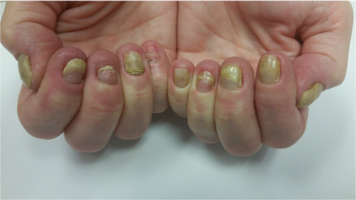File:Yellow nail syndrome 1.png