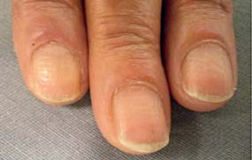 File:Pitted nails with Alopecia universalis 1.png