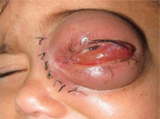 File:Mucormycosis eye.png
