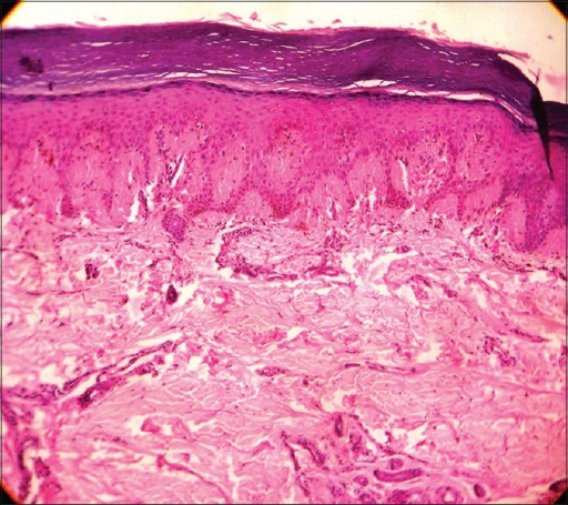 File:Laugier-Hunziker Syndrome histology.png