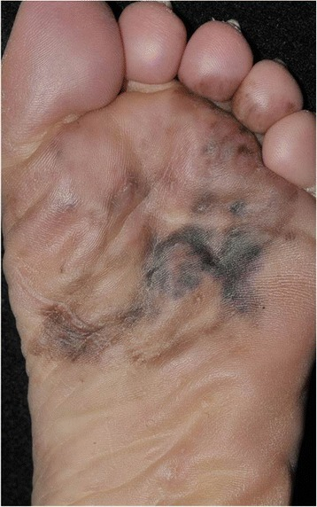 File:Acral lentiginous melanoma 3.png
