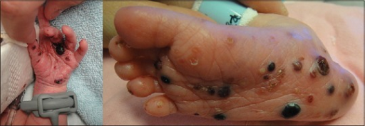 purplish bumps in skin due to neonatal Langerhans cell histiocytosis