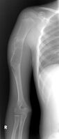 X-ray: chondromyxoid fibroma upper arm