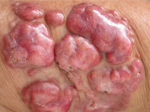 Nodular plaques covered by smooth and shiny skin