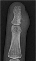 X-Ray right middle finger: juxta-cortical chondroma