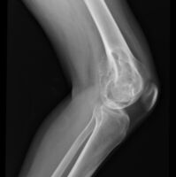 X-ray: chondromyxoid fibroma upper leg near knee