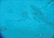 Lactophenol cotton blue preparation showed mature sporangia of Mucor species