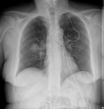 Chest X-ray: likely fungal infection left lung in an immunocompromised person