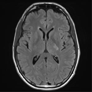 MRI brain: cryptococcus