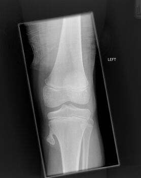 Osteochondroma arising from the large long bone of lower leg, near the knee