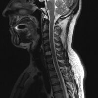 2.a. MRI neck (side view): solitary plasmacytoma C6