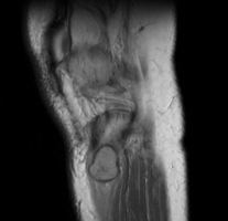 MRI right knee: periosteal chondroma