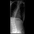 X-ray: osteoblastoma causing bent spine
