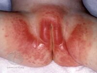 Diaper rash in a female[7]