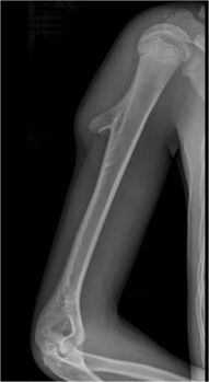 Osteochondroma arising from long bone of the upper arm, near shoulder