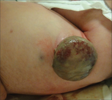 large bump on tummy of newborn with Langerhans cell histiocytosis