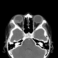 CT-scan head: Intraorbital enhancing mass lesion and two outer eyelid lesions with necrotic center and enhancing borders.